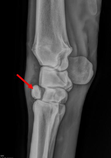 carpal fracture