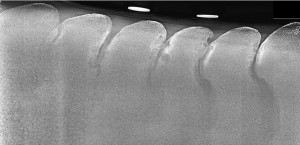 Overriding Dorsal Spinous Processes, commonly known as 'Kissing Spines'